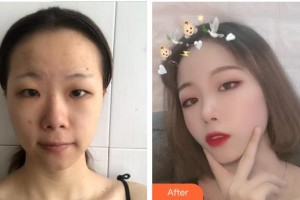 南平時(shí)光醫(yī)療美容門(mén)診部廖振浩整形價(jià)格表附埋線提升案例展示