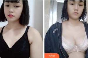 南平時(shí)光醫(yī)療美容門(mén)診部侯銳樺整形價(jià)格表附隆胸案例展示