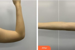 南平時(shí)光醫(yī)療美容門(mén)診部金永奎整形價(jià)格表附手臂吸脂案例展示