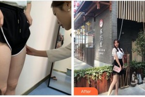 南平時(shí)光醫(yī)療美容門(mén)診部周偉整形價(jià)格表附大腿吸脂案例展示