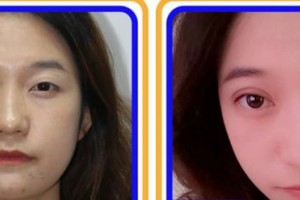 南平華廈眼科醫(yī)院林巧妹整形價(jià)格表附眼部綜合案例展示