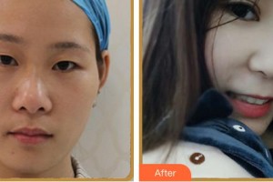 南平華廈眼科醫(yī)院莊永軍整形價格表附雙眼皮案例展示