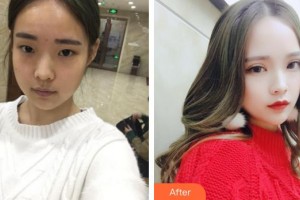 南平武夷厚生眼科醫(yī)院賈惠莉整形價格表附眼部手術案例展示