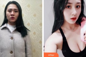 龍巖歐菲醫(yī)療美容門診部黃朝暉整形價格表附假體豐胸案例展示