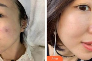 龍巖華美醫(yī)療美容醫(yī)院盧云整形價格表附激光美膚激光案例展示