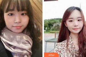 龍巖歐菲醫(yī)療美容門診部劉燕整形價格表附激光美膚激光案例展示