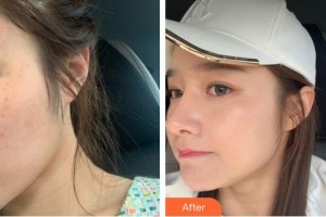 龍巖歐菲醫(yī)療美容門診部陳玉珠整形價格表附超激光美膚案例展示