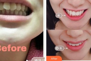 龍巖華美醫(yī)療美容醫(yī)院林才娘整形價格表附牙齒矯正案例展示