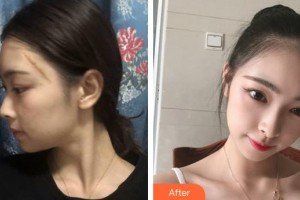 龍巖人民醫(yī)院燒傷整形科林財輝整形價格表附疤痕案例展示