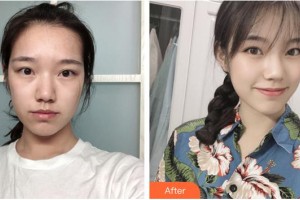 龍巖人民醫(yī)院燒傷整形科熊建華整形價格表附疤痕案例展示