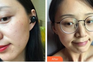 寧德時代醫(yī)院整形美容科覃建云整形價格表附超激光美膚案例展示