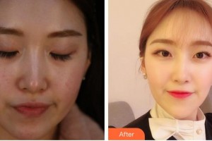 寧德東韓整形美容醫(yī)院熊舒原整形價格表附超激光美膚案例展示