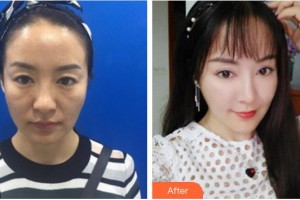 寧德東韓整形美容醫(yī)院莊載世整形價格表附埋線提升案例展示