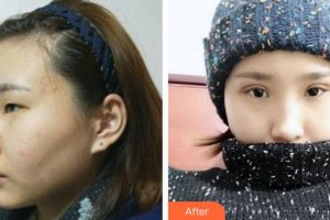 寧德愛爾眼科醫(yī)院劉漢生整形價格表附眼部手術案例展示