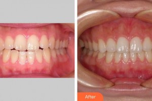 寧德中富口腔醫(yī)院王琳勇整形價格表附牙綜合案例展示