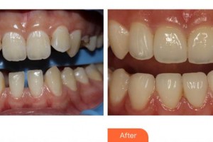 寧德中富口腔醫(yī)院楊順整形價格表附隱形托槽矯正案例展示