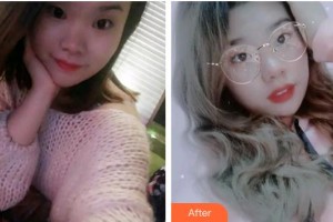 寧德中富口腔醫(yī)院謝曉婷整形價格表附牙齒隱形矯正案例展示