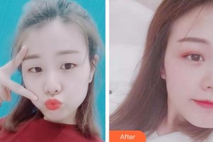 安徽立新醫(yī)學(xué)美容門診部周著祖整形價(jià)格表附雙眼皮案例展示