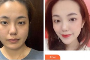 安徽韓美整形美容醫(yī)院石顯武整形價(jià)格表附埋線提升提升案例展示