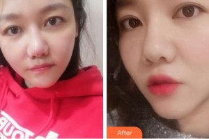 安徽韓美整形美容醫(yī)院蔣炎春整形價(jià)格表附埋線提升案例展示