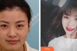 安徽立新醫(yī)學(xué)美容門診部楊義整形價(jià)格表附激光美膚激光案例展示