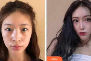 安徽立新醫(yī)學(xué)美容門診部朱慧茹整形價(jià)格表附切開雙眼皮案例展示