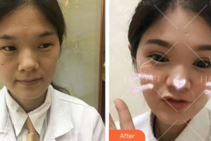 安徽立新醫(yī)學(xué)美容門診部李鐘輝整形價(jià)格表附雙眼皮案例展示