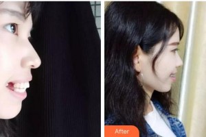 安徽韓美整形美容醫(yī)院姜山整形價(jià)格表附齙牙小仙女案例展示