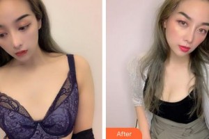 安徽省立醫(yī)院整形燒傷外科水慶付整形價(jià)格表附濃縮豐胸案例展示