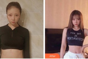 安徽省立醫(yī)院整形燒傷外科褚燕軍整形價(jià)格表附疤痕案例展示