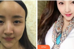 安徽省立醫(yī)院整形燒傷外科杜曉楊整形價(jià)格表附鼻部案例展示