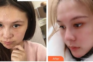 安徽省立醫(yī)院整形燒傷外科趙李平整形價(jià)格表附網(wǎng)紅小翹鼻案例展示