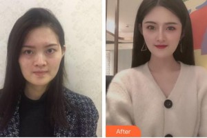 安徽省立醫(yī)院整形燒傷外科余剛整形價(jià)格表附半肋軟骨隆鼻案例展示