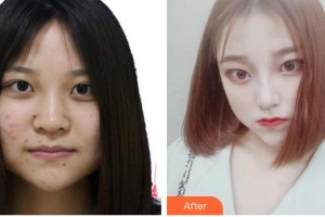 安徽醫(yī)科大學(xué)第一附屬醫(yī)院整形美容中心朱飛整形價(jià)格表附鼻部手術(shù)案例展示