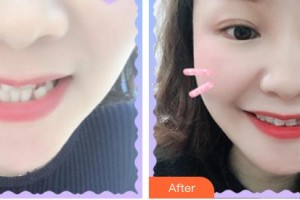 安徽長征微創(chuàng)外科醫(yī)院整形美容科張智整形價(jià)格表附牙齒矯正案例展示