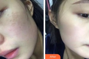 安徽長征微創(chuàng)外科醫(yī)院整形美容科何燕整形價(jià)格表附超激光美膚案例展示