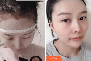 安徽長征微創(chuàng)外科醫(yī)院整形美容科邸偉整形價(jià)格表附發(fā)際線案例展示