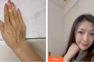 武警安徽總隊(duì)醫(yī)院皮膚美容科袁鋒整形價格表附手術(shù)祛疤案例展示