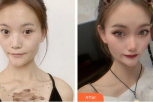 武警安徽總隊(duì)醫(yī)院皮膚美容科郭明亮整形價格表附祛疤案例展示