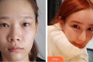 安徽韓美整形美容醫(yī)院劉冷整形價格表附隆鼻案例展示