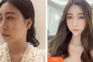 安徽韓美整形美容醫(yī)院李瑞整形價格表附[美鼻+媚眼]鼻眼部手術(shù)案例展示