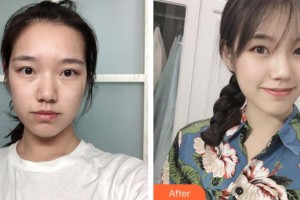 安徽韓美整形美容醫(yī)院吳金平整形價格表附疤痕案例展示