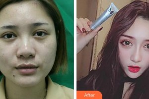 安徽醫(yī)科大學(xué)附屬巢湖醫(yī)院燒傷整形科劉安軍整形價格表附鼻部綜合案例展示