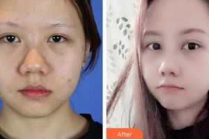 安徽醫(yī)科大學(xué)附屬巢湖醫(yī)院燒傷整形科葛禮正整形價格表附鼻部整形案例展示