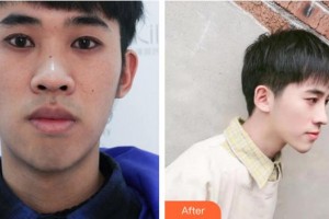 安徽維納斯醫(yī)院整形外科刑志平整形價格表附鼻部手術(shù)案例展示