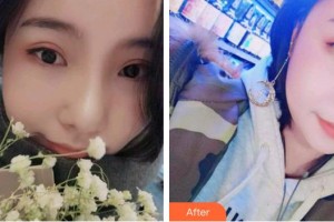 安徽天鵝湖口腔醫(yī)院閆勇整形價格表附牙齒矯正案例展示