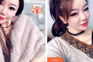 安徽天鵝湖口腔醫(yī)院吳翔整形價格表附牙齒隱形矯正案例展示