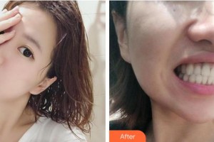 安徽醫(yī)科大學(xué)口腔醫(yī)學(xué)院王海林整形價格表附隱形托槽矯正案例展示