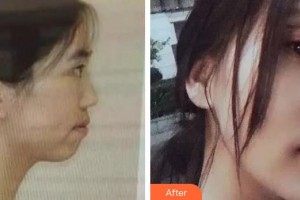 安徽醫(yī)科大學(xué)口腔醫(yī)學(xué)院徐文華整形價格表附金屬托槽矯正案例展示