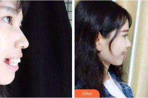 安徽醫(yī)科大學(xué)口腔醫(yī)學(xué)院何家才整形價格表附齙牙小仙女案例展示